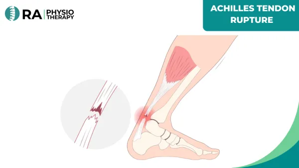 Achilles Tendon Rupture