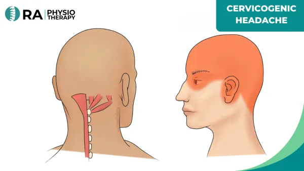 Cervicogenic Headache
