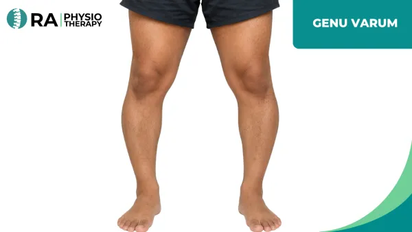 Genu Varum