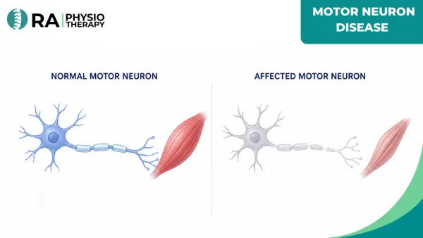 Motor Neuron Disease (mnd)