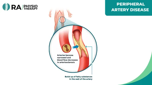 Peripheral Artery Disease (pad)