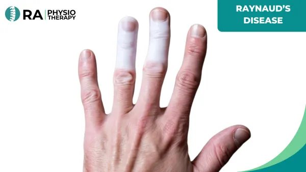 Raynaud’s Disease