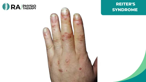 Reiter's Syndrome