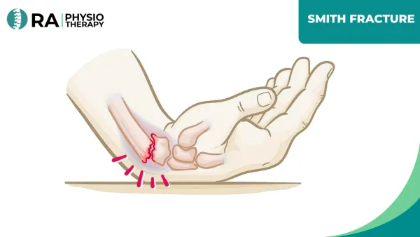 Smith Fracture