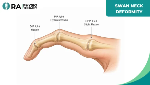 Swan Neck Deformity