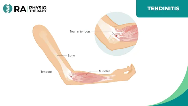 Tendinitis