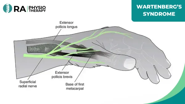 Wartenberg’s Syndrome